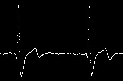 ECG monitor